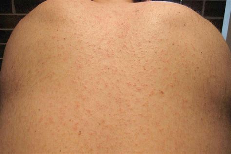 16 Causes of Viral Rashes With Pictures