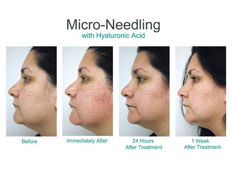 Micro Needling Neck Before And After