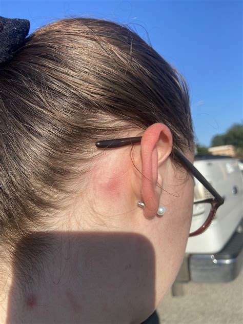 Posterior Auricular Lymph Node