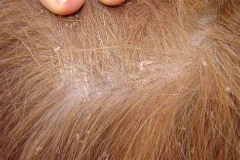 how to treat seborrheic dermatitis in dogs