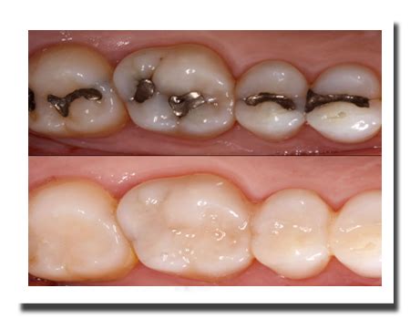 Tooth Colored Fillings – Meeradental Hospital