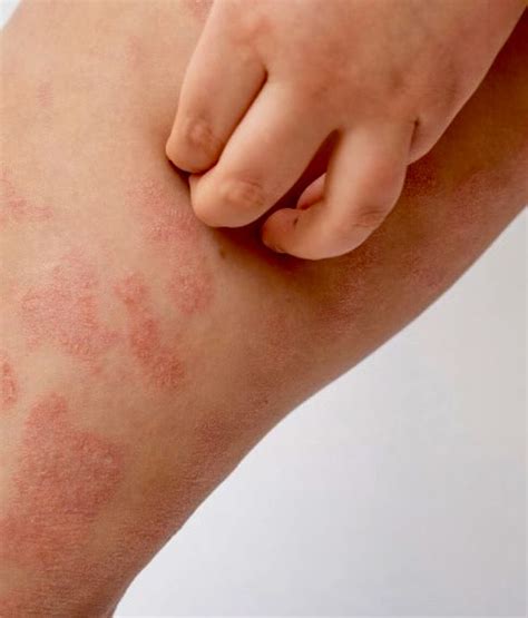 Is you eczema flaring up? – Foot Culture