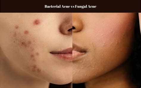 Fungal Acne vs Bacterial Acne: Identifying and Treating Different Acne ...