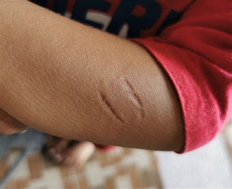 human bites lead  infection