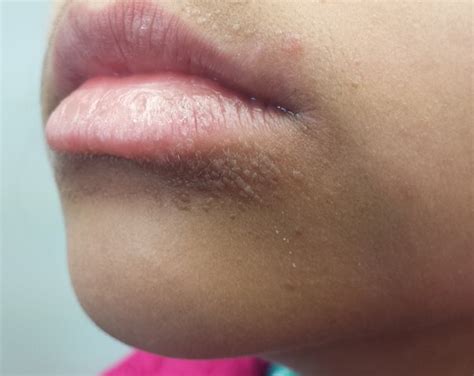 Small Pimples Near Lips | Lipstutorial.org