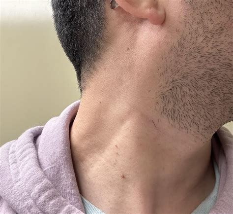 Swollen lymph nodes : r/lymphnodes