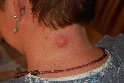 Sebaceous Cysts, What is a Sebaceous Cyst? - Dr. Michele Green M.D.