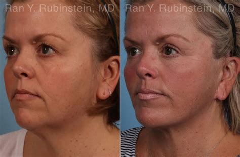 Laser Neck Lift Before And After – SkinTots.com