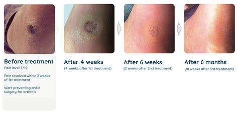 wart removal treatment    rid  warts australian wart clinic