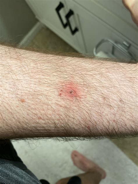 Brown Recluse Spider Bite First Stage