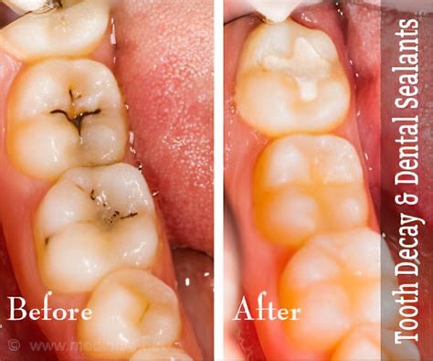 Sealants Before And After - Dental Sealants In San Marcos Larry D ...