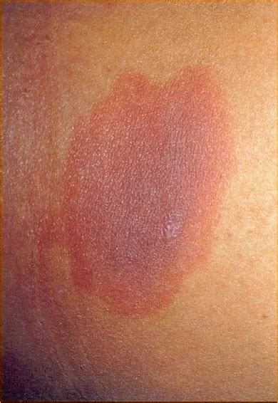 Eritematosa O Que É - Erupcao Cutanea Eritematosa Difusa Exantema Maculopapular
