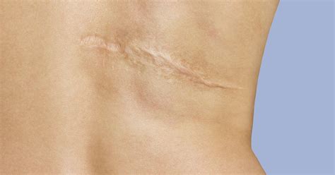 rid  acne scars home remedies scars treatment