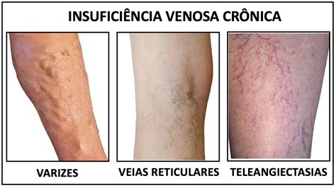 Insuficiencia Venosa O Que É - Insuficiência Venosa Crônica - Medicina de Excelência