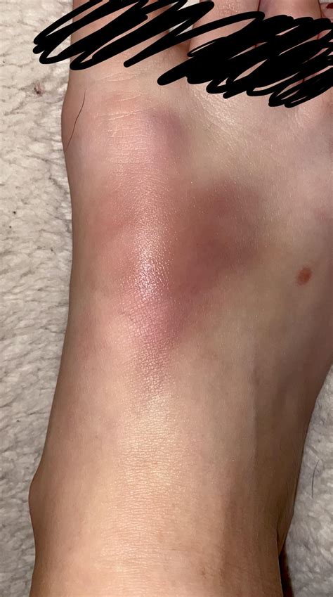 Has anyone else got a bruise like this on their foot! I can not even