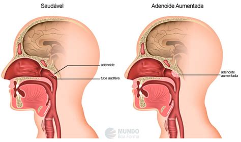 O Que E Adenoide No Nariz - Carne no nariz - Causas e como tratar - MundoBoaForma