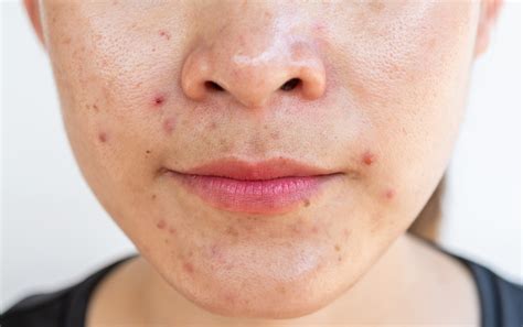 acne treatment birmingham al alabaster acne treatment