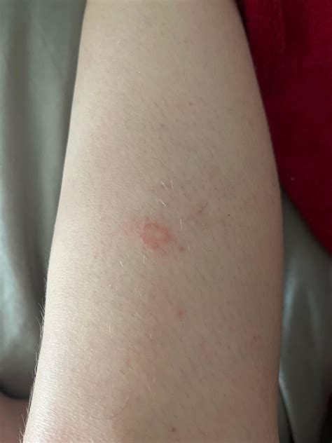 Itchy patch- melanoma? : r/Melanoma
