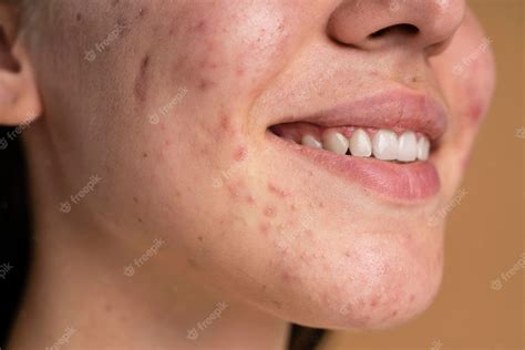 Pimple Wallpapers - Top Free Pimple Backgrounds - WallpaperAccess