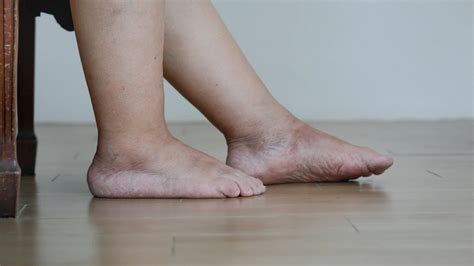Bàn chân Charcot ở bệnh nhân tiểu đường - Nhà thuốc FPT Long Châu