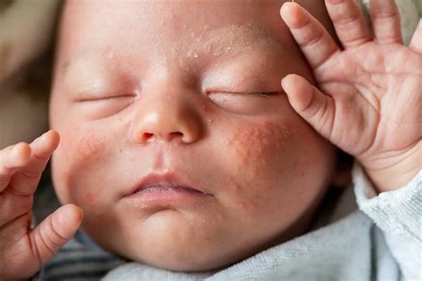 how to fix baby acne