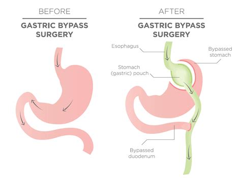 gastric bypass surgery cost  surgical weight loss centre