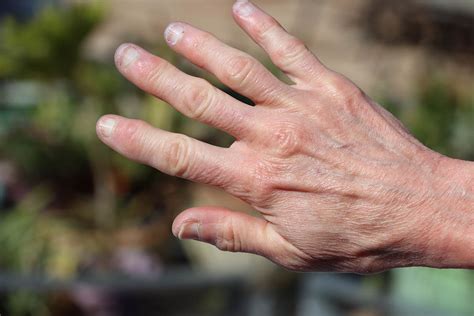 heberden arthrose finger fingergelenkarthrose ursachen symptome