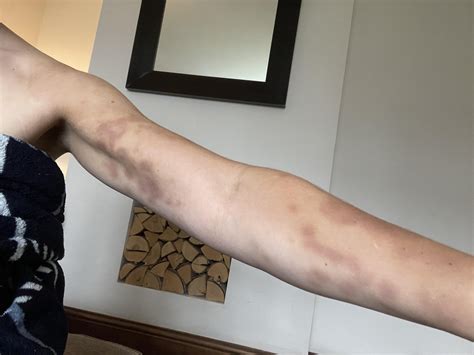 Lovenox Bruises