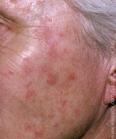 basal cell carcinoma early stages face