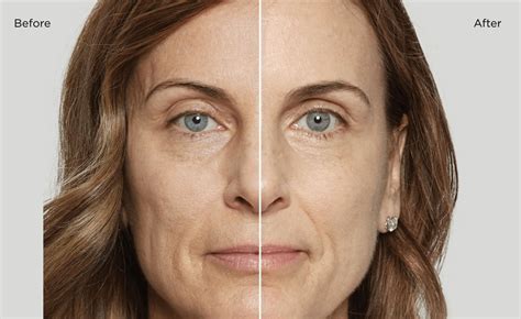 Biostimulator Treatments | The Manse Clinic Sydney