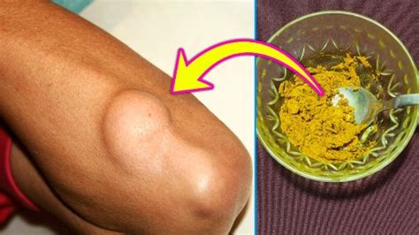 How To Remove Lipoma Naturally At Home, Lipoma Removal Home Remedy ...