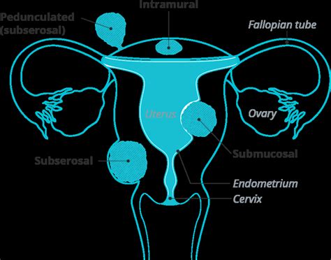 subserosal fibroid responsum  fibroids
