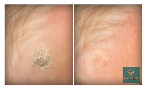 Wart & Verruca Removal Glasgow | Laser Treatment Clinic Scotland