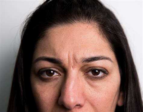 frown lines treatment twickenham thames skin clinic