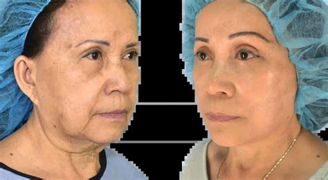 endoscopic facelift procedure cost wave plastic surgery