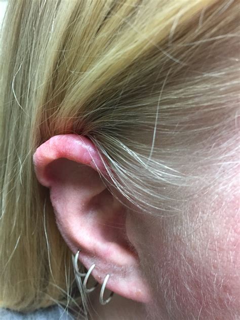 Hypertrophic Scar Piercing