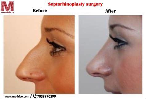 My Nose Shape Has Changed