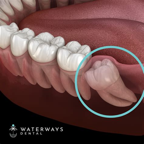Wisdom Tooth Removal After