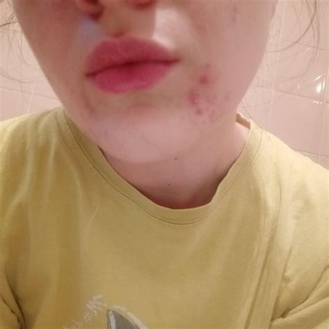 recurring pimples    part   face acne