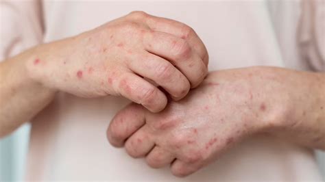 Skin Health: Here Are 5 Infections That Can Seriously Damage Skin | OnlyMyHealth