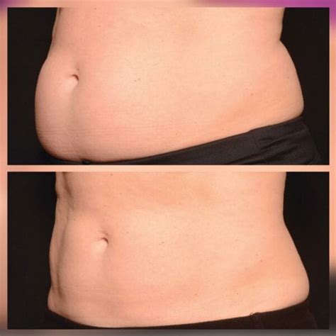 Coolsculpting Cost, Benefits, Side Effects & More | Bodycraft