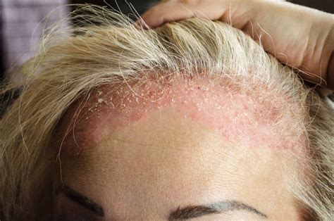 Dermatite Na Cabeça Como Tratar