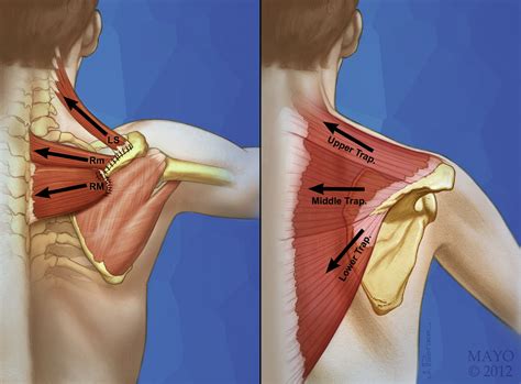 Outcome of triple-tendon transfer, an Eden-Lange variant, to