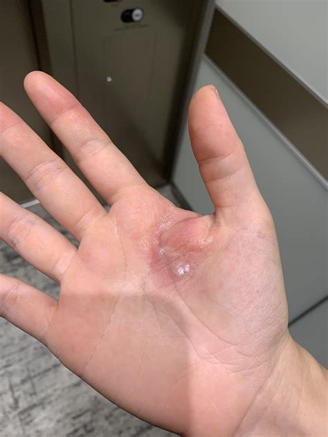 Does this look like chilblains? : r/ReynaudsDisease