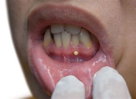 Gum Boils: A Comprehensive Guide to Managing Dental Abscesses - Care ...