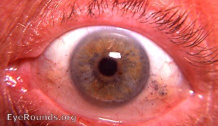 Conjunctival Foreign Body