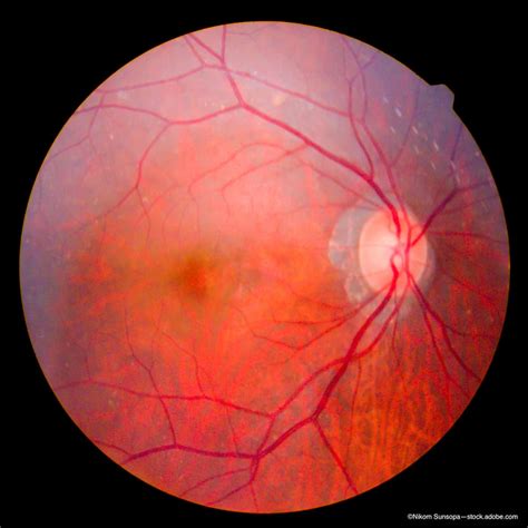 unraveling burdens   linked retinitis pigmentosa
