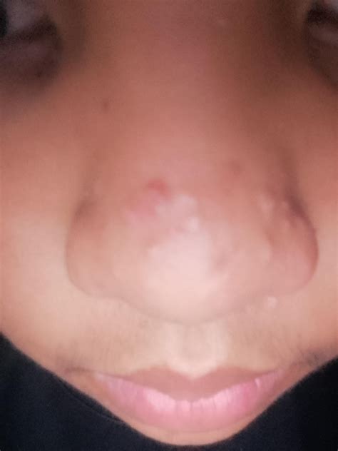 What are these bumps on my nose? They aren't pimples and they don't