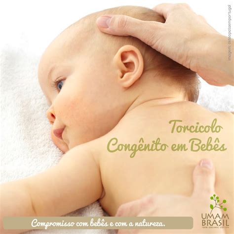 Como Saber Se O Bebe Tem Torcicolo Congenito - Torcicolo congênito