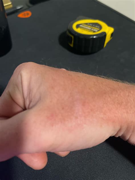 What do you think this is? Wart? : r/Warts